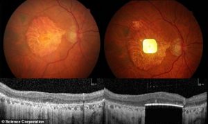 In trials, participants were able to read letters, numbers and words using the prosthetic vision system. Pictured, image of the electronic chip in a patient's eye