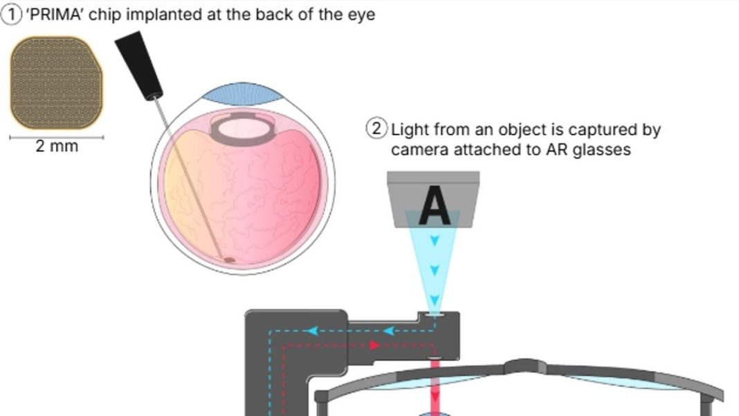 Measuring just 2mm x 2mm, the 'pioneering' implant is paired with a special pair of augmented reality (AR) glasses, equipped with a camera