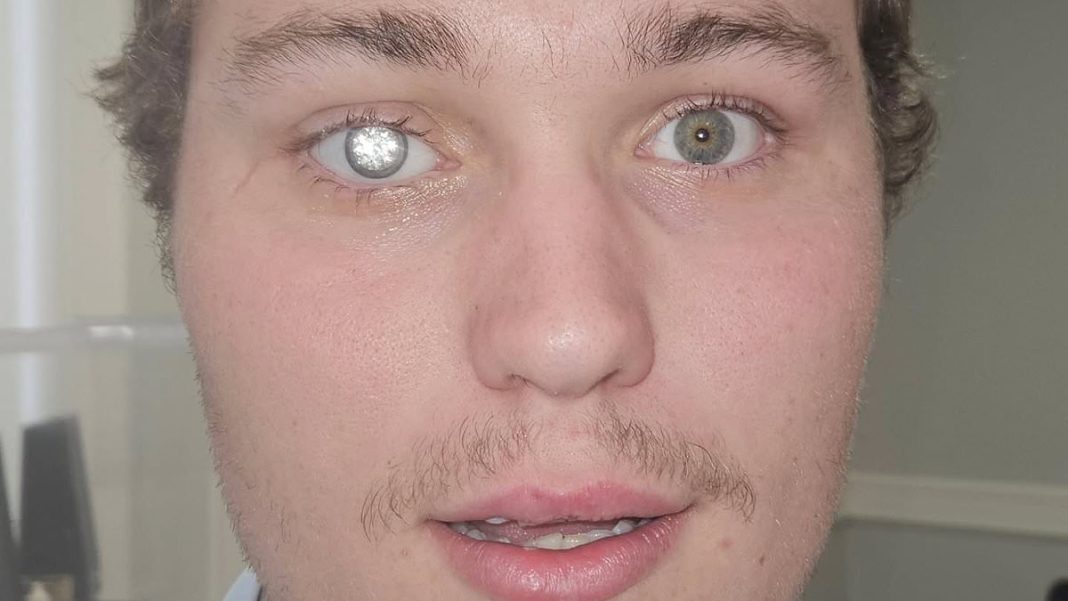 A jewellery store owner from Alabama has given himself an eye-catching look fit for a Bond villain after installing a two-carat diamond into his prosthetic eye 