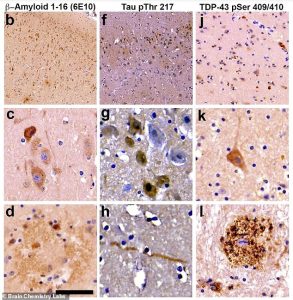 Scientists found the hallmarks of Alzheimer's in the brains of all the dolphins tested, including misfolded tau proteins (center), amyloid plaques (left) and tangled fibers (right) that destroy neural connections