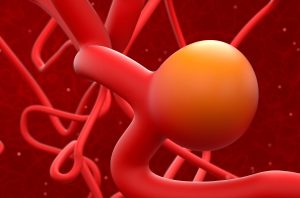 Close up illustration of a brain aneurysm (Alamy/pa)