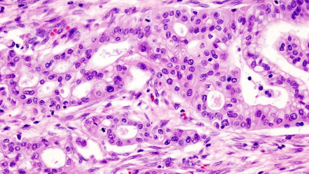 Micrograph of pancreatic ductal adenocarcinoma, a common type of pancreatic cancer. | Photo Credit: KGH (CC BY-SA)