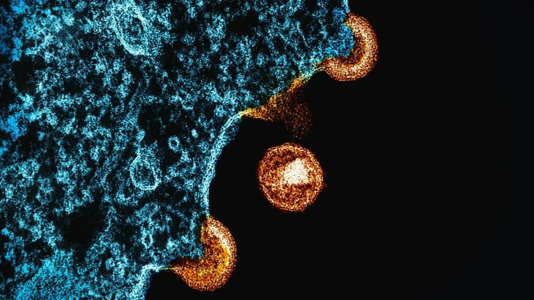 A transmission electron micrograph of HIV-1 virus particles (orange) from infected H9 cells, produced in cell culture. | Photo Credit: US NIAID