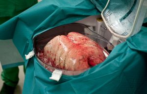 A human lung is seen during a lung transplant procedure. (Photo: Reuters)