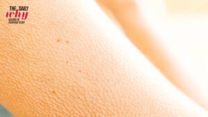 Tiny bumps on skin are seen as a person feels goosebumps. (Photo: Getty)