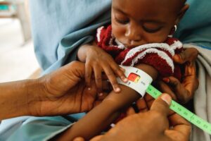 A child is diagnosed with severe acute malnutrition in Dikwa, Nigeria. (Photo: AP)