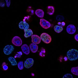 In gene therapy for sickle cell disease, doctors remove blood-forming stem cells from the patient's bone marrow. (Photo: Unsplash)